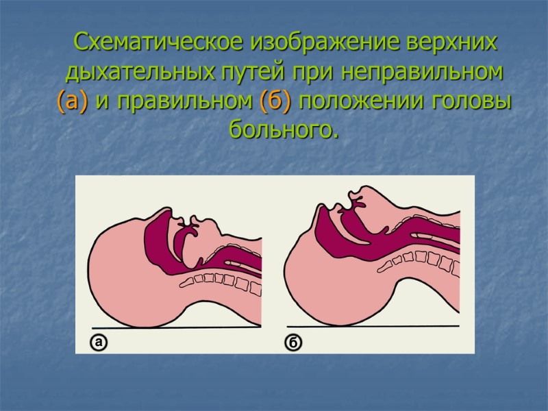 >Схематическое изображение верхних дыхательных путей при неправильном (а) и правильном (б) положении головы больного.